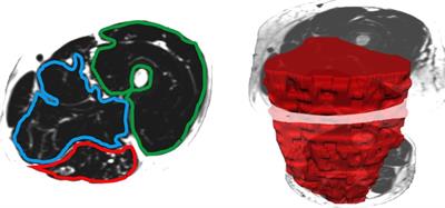Muscle adaptations in acute SCI following overground exoskeleton + FES training: A pilot study